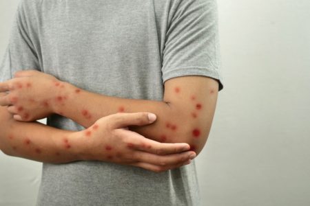 Foto colorida de homem com feridas de mpox nos braços - Metrópoles