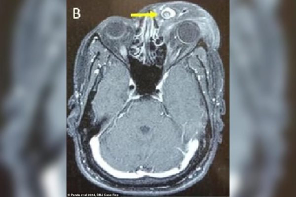 Uma tomografia cerebral antes da cirurgia mostrou a massa, feita de pele e tecido sanguíneo, que estava grudada na pálpebra esquerda do homem . Metrópoles