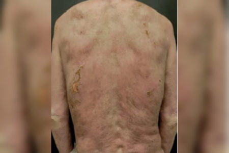 Fotos mostram a evolução de tratamento da necrólise epidérmica tóxica