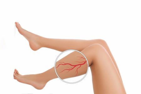 Pernas de mulher cortada com varizes close-up com lupa, isoladas em fundo branco. Varizes aterosclerose doença periferica obstrutiva