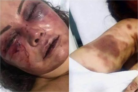 A paisagista Elaine Peres Caparroz ficou com o rosto desfigurado apos ser agredida pelo lutador de jiu-jitsu Vinicius Serra