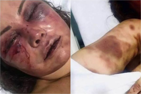 A paisagista Elaine Peres Caparroz ficou com o rosto desfigurado apos ser agredida pelo lutador de jiu-jitsu Vinicius Serra
