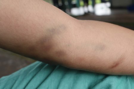Foto colorida de braço cheio de hematomas