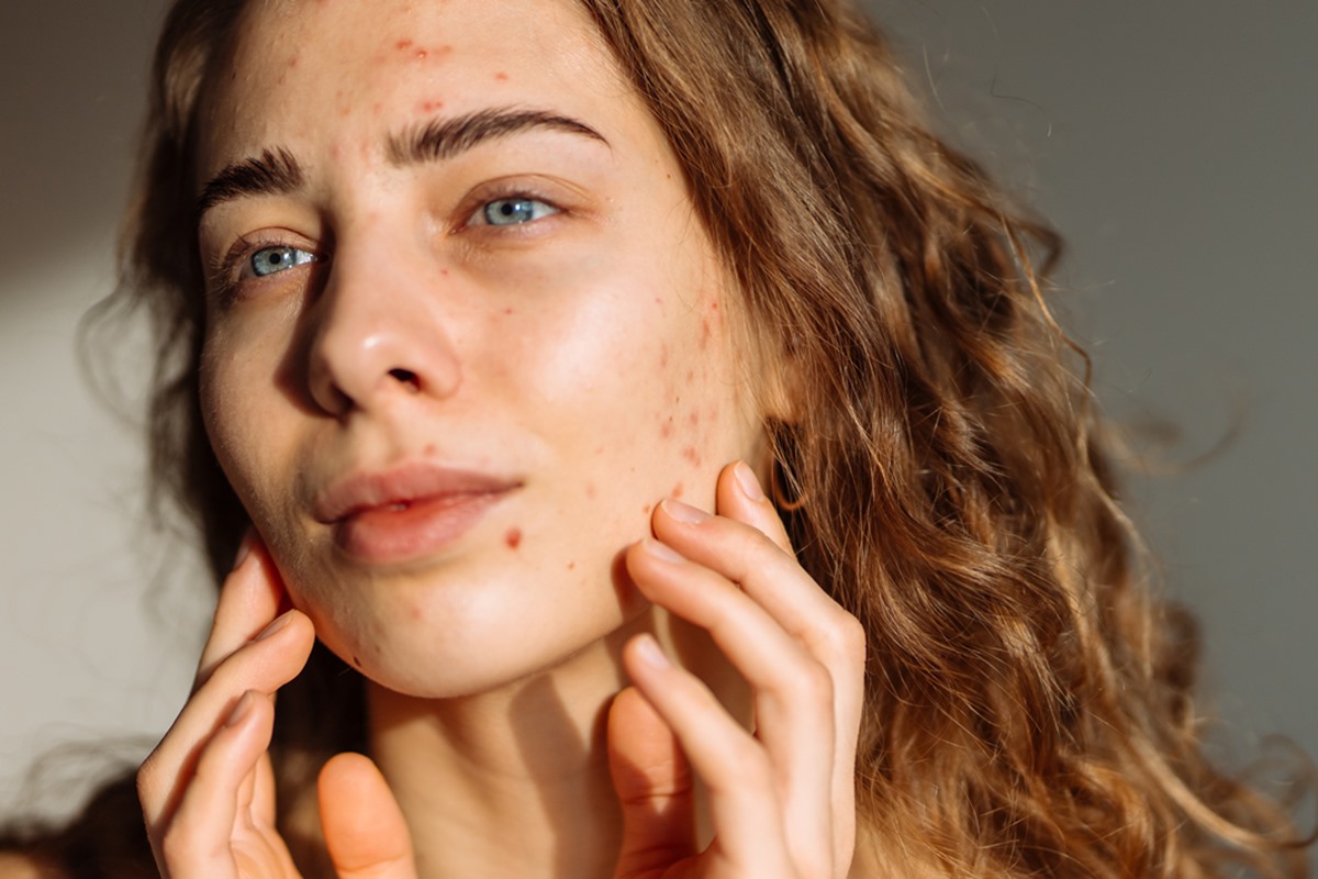 Cicatrizes de acne