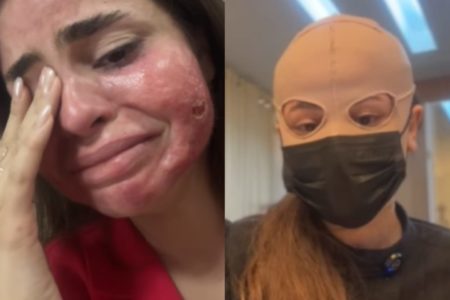 Foto médica Isadora Millhomen peeling 3