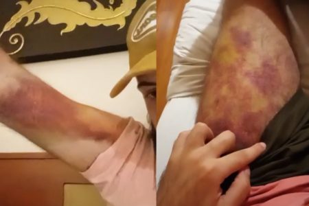 Imagens coloridas dos hematomas de Phelipe de Moura Ferreira, vítima de tráfico humano no Mianmar. - Metrópoles