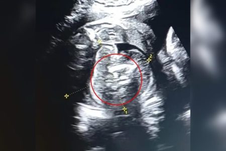 Imagem de ultrassom de bebê com dois feos dentro da barriga. Metrópoles