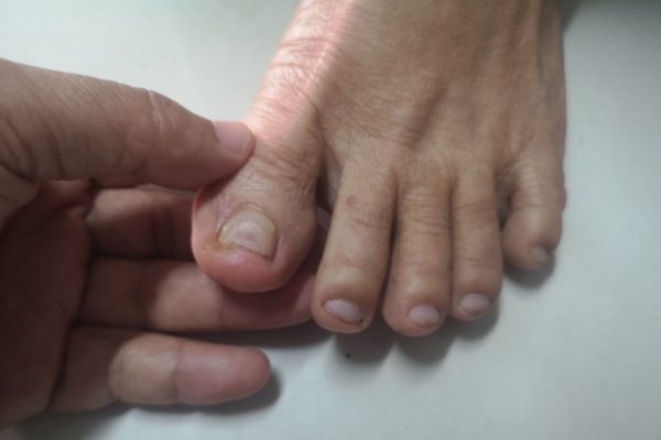 Foto colorida de um micose de unha - Metrópoles