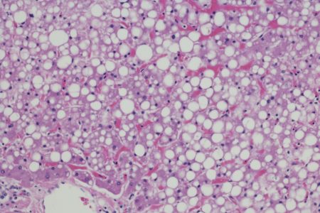 Imagem mostra visão de microscópio do tecido do fígado com gordura - Metrópoles