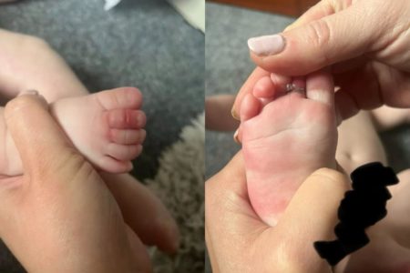Bebê fica com cabelos presos nos dedos dos pés. Mãe alerta sobre cuidado com lavagem de roupa. Metrópoles